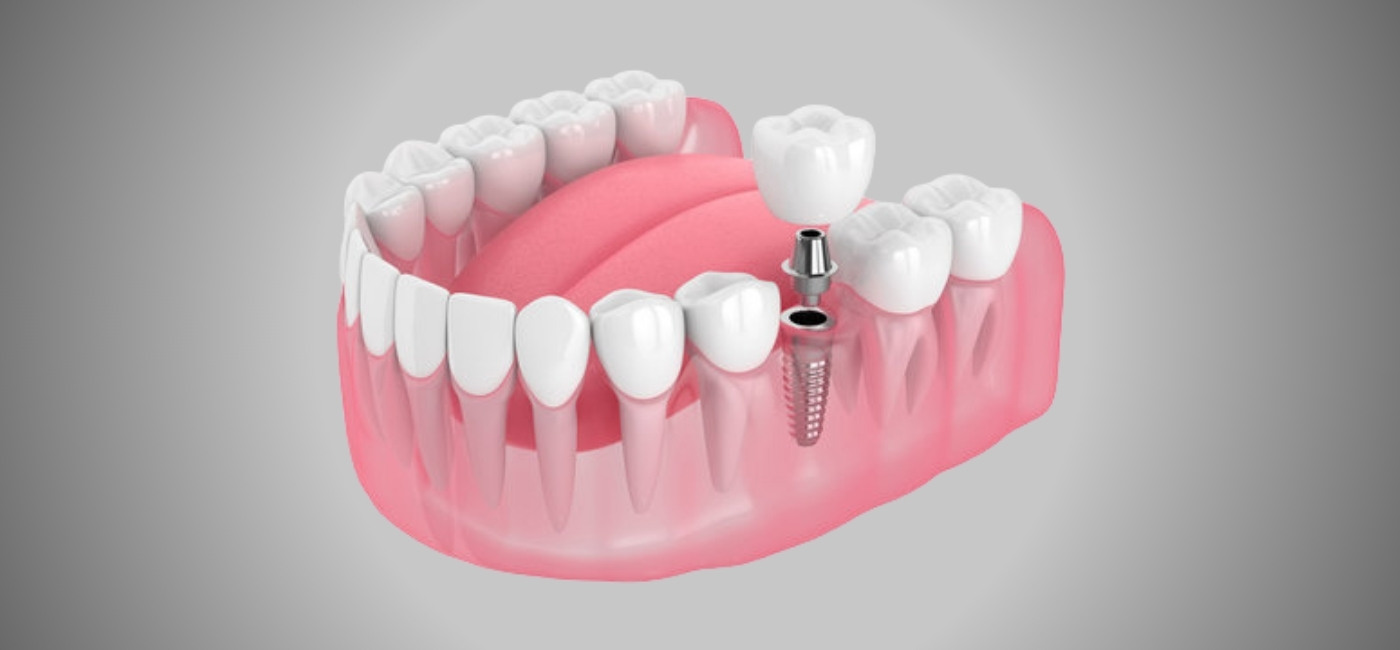 Dental Implants