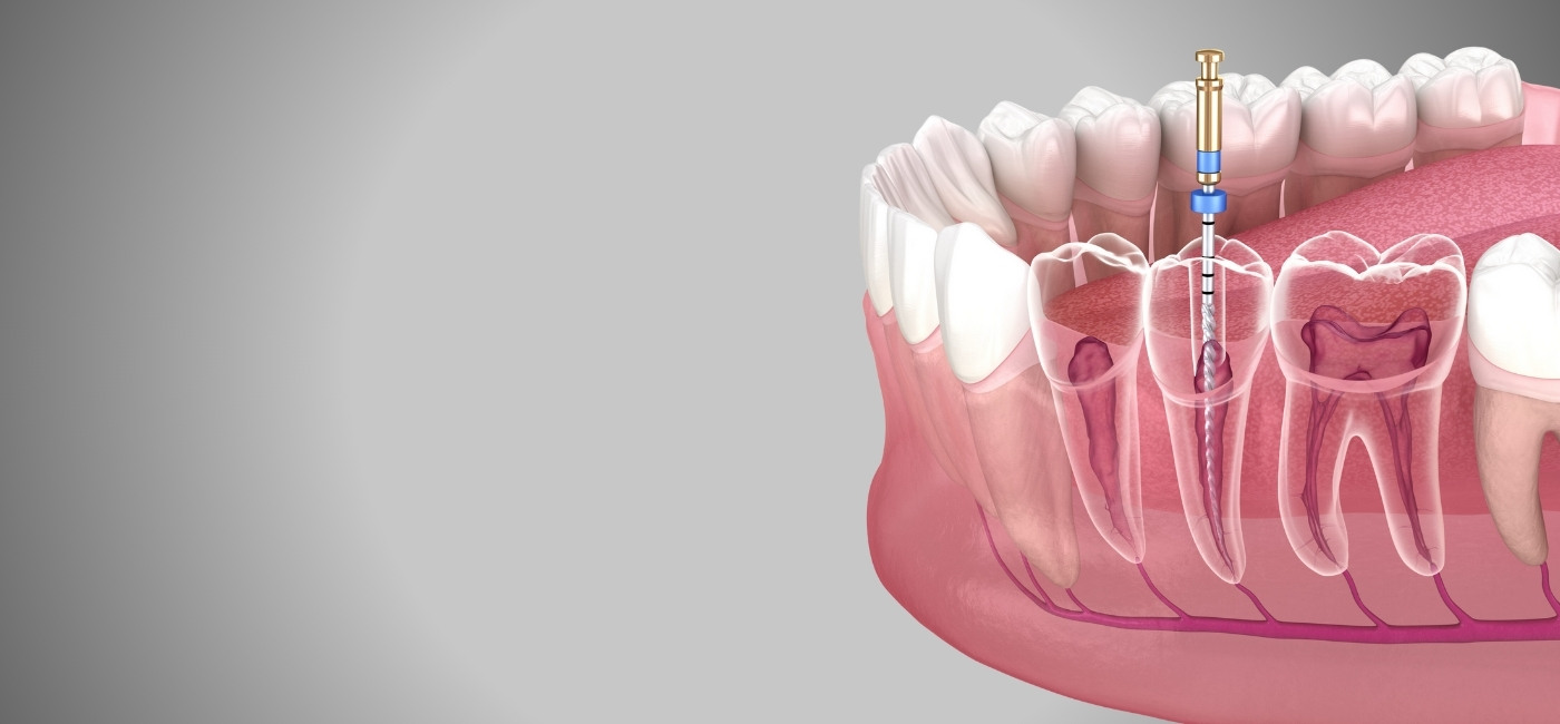 Root Canal